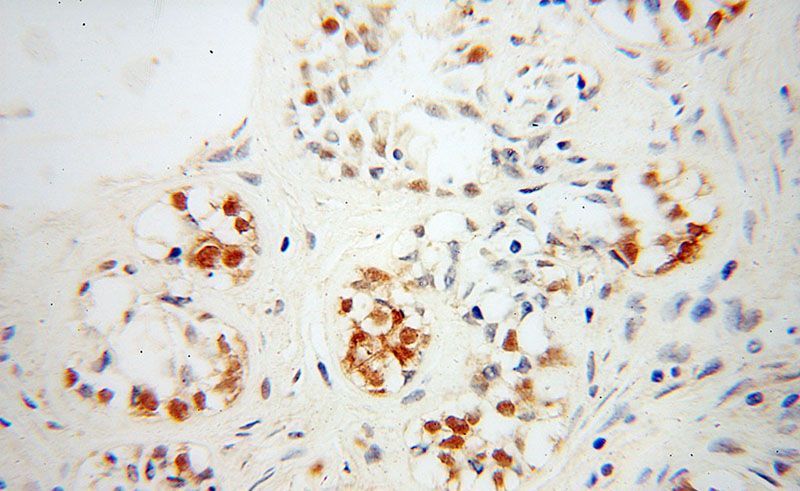 Immunohistochemical of paraffin-embedded human breast cancer using Catalog No:116875(XRCC4 antibody) at dilution of 1:100 (under 40x lens)