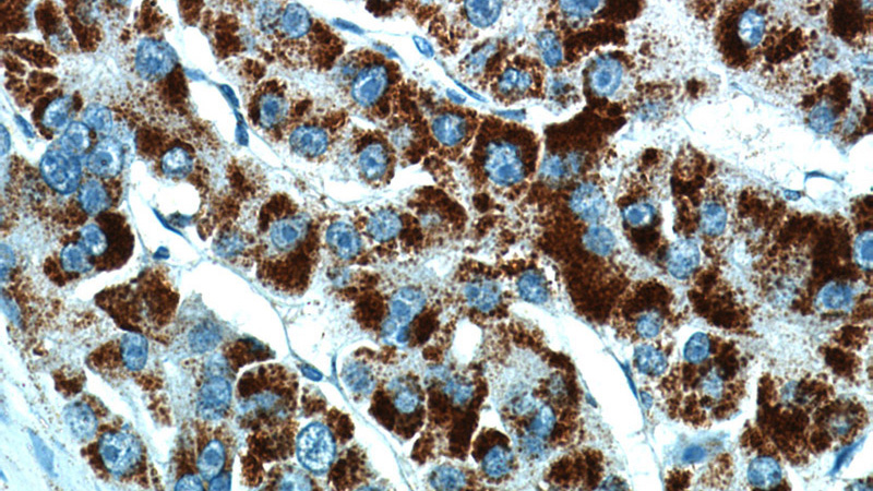 Immunohistochemical of paraffin-embedded human liver cancer using Catalog No:113727(PEX14 antibody) at dilution of 1:50 (under 40x lens)