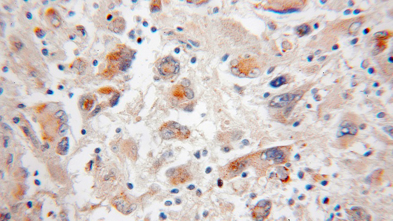 Immunohistochemical of paraffin-embedded human medulloblastoma using Catalog No:113524(SCOT antibody) at dilution of 1:50 (under 10x lens)