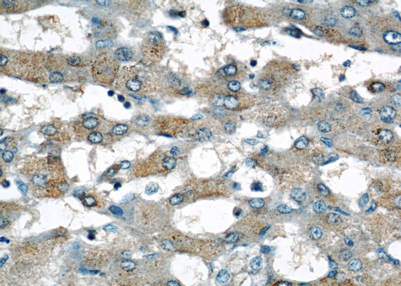 Immunohistochemical of paraffin-embedded human hepatocirrhosis using Catalog No:115038(SAA2 antibody) at dilution of 1:50 (under 40x lens)