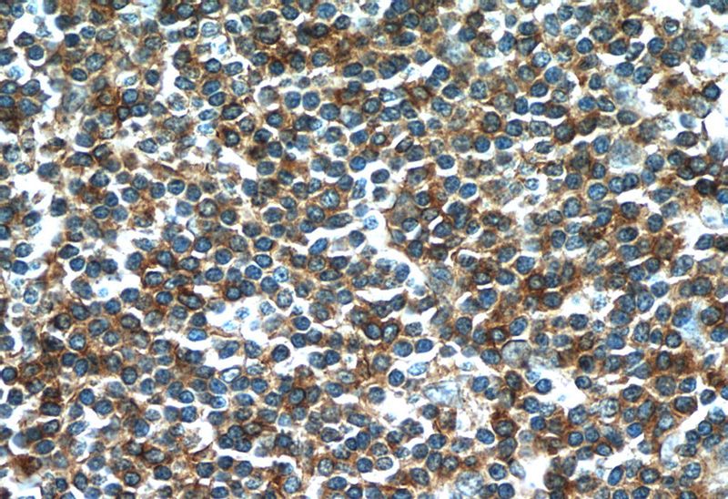 Immunohistochemistry of paraffin-embedded human tonsillitis tissue slide using Catalog No:109309(BIRC3 Antibody) at dilution of 1:50 (under 40x lens)