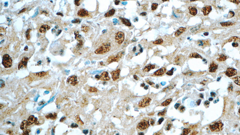 Immunohistochemistry of paraffin-embedded human cervical cancer tissue slide using Catalog No:115456(SNRPA Antibody) at dilution of 1:50 (under 40x lens)