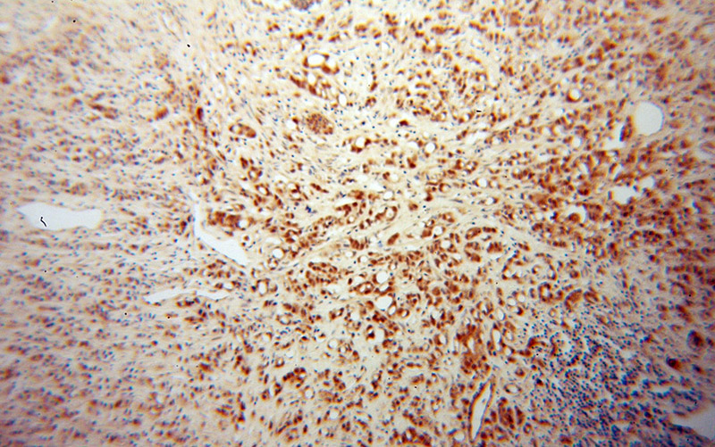 Immunohistochemical of paraffin-embedded human prostate cancer using Catalog No:111874(INTS5 antibody) at dilution of 1:100 (under 10x lens)