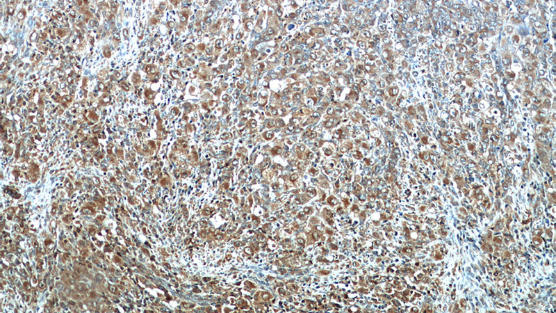 Immunohistochemical of paraffin-embedded human lymphoma using Catalog No:109123(SPN antibody) at dilution of 1:50 (under 10x lens)