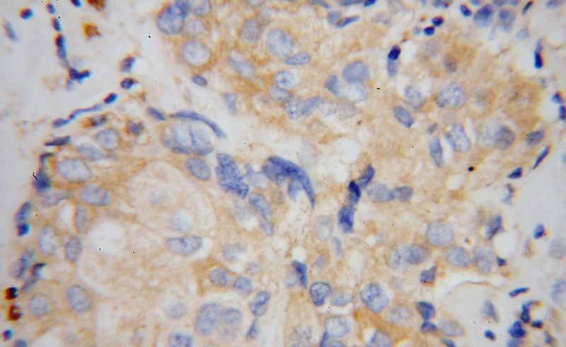 Immunohistochemical of paraffin-embedded human breast cancer using Catalog No:110444(FABP7-Specific antibody) at dilution of 1:100 (under 40x lens)