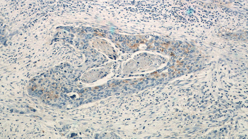 Immunohistochemistry of paraffin-embedded human cervical cancer tissue slide using Catalog No:115088(SEC61B-Specific Antibody) at dilution of 1:50 (under 10x lens)