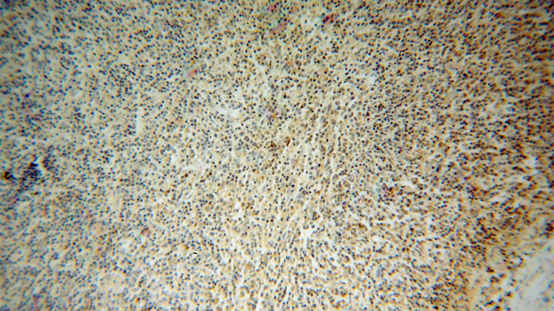 Immunohistochemical of paraffin-embedded human lymphoma using Catalog No:111322(GZMB antibody) at dilution of 1:100 (under 10x lens)