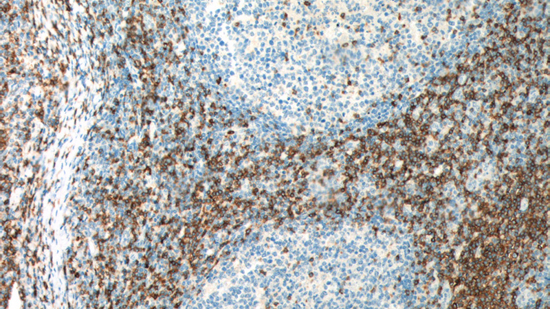 Immunohistochemistry of paraffin-embedded human tonsillitis tissue slide using Catalog No:107141(CD7 Antibody) at dilution of 1:200 (under 10x lens). heat mediated antigen retrieved with Tris-EDTA buffer(pH9).