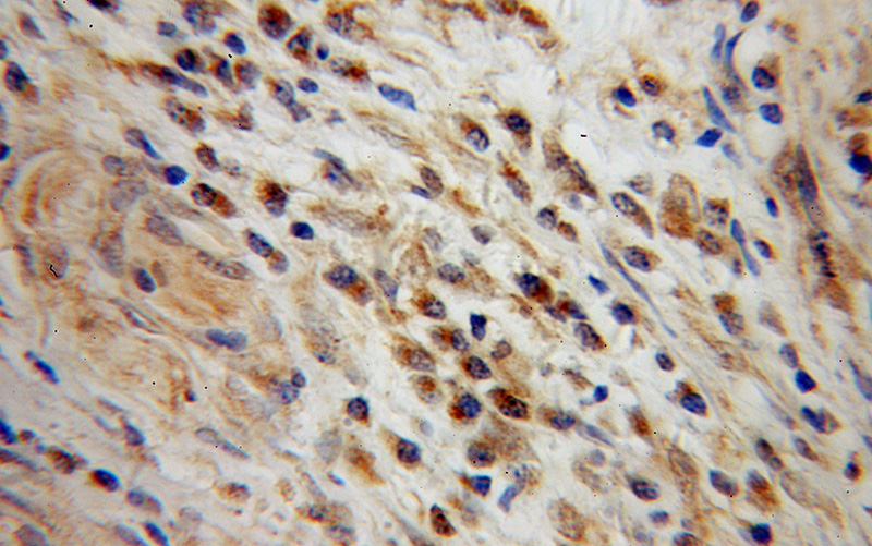 Immunohistochemical of paraffin-embedded human cervical cancer using Catalog No:114108(PPP3CA antibody) at dilution of 1:100 (under 40x lens)