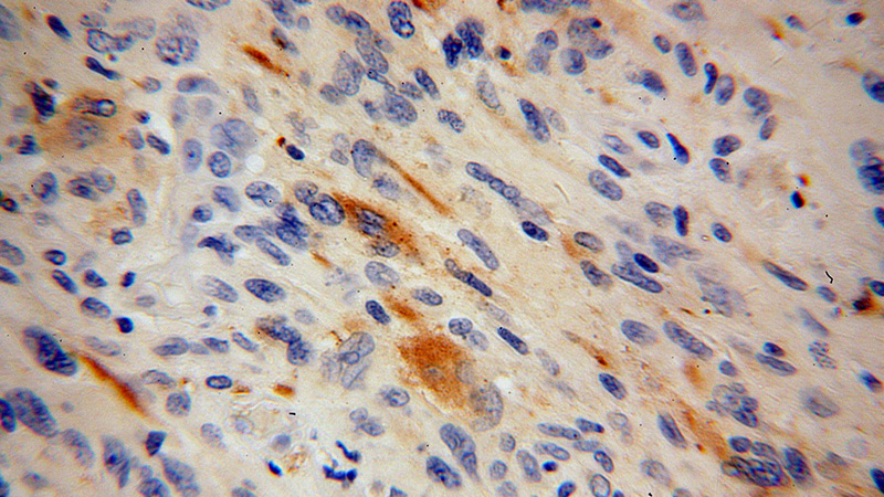 Immunohistochemical of paraffin-embedded human gliomas using Catalog No:114649(RGS7 antibody) at dilution of 1:50 (under 40x lens)