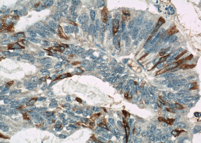 Immunohistochemical of paraffin-embedded human ovary tumor using Catalog No:107433(MUC16,CA125 antibody) at dilution of 1:50 (under 40x lens)