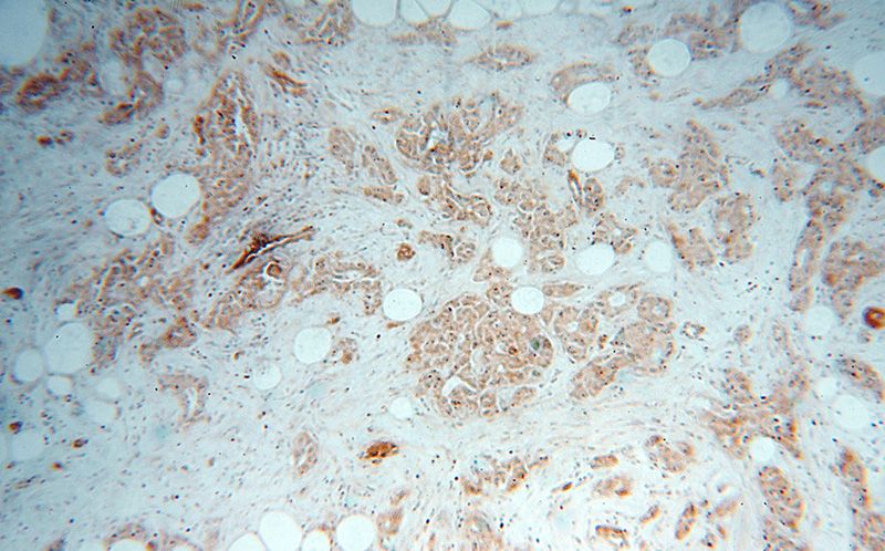 Immunohistochemical of paraffin-embedded human breast cancer using Catalog No:108824(CALM3 antibody) at dilution of 1:50 (under 10x lens)