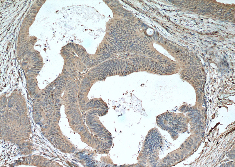 Immunohistochemistry of paraffin-embedded human colon cancer tissue slide using Catalog No:107529(Sestrin2 Antibody) at dilution of 1:200 (under 10x lens). heat mediated antigen retrieved with Tris-EDTA buffer(pH9).