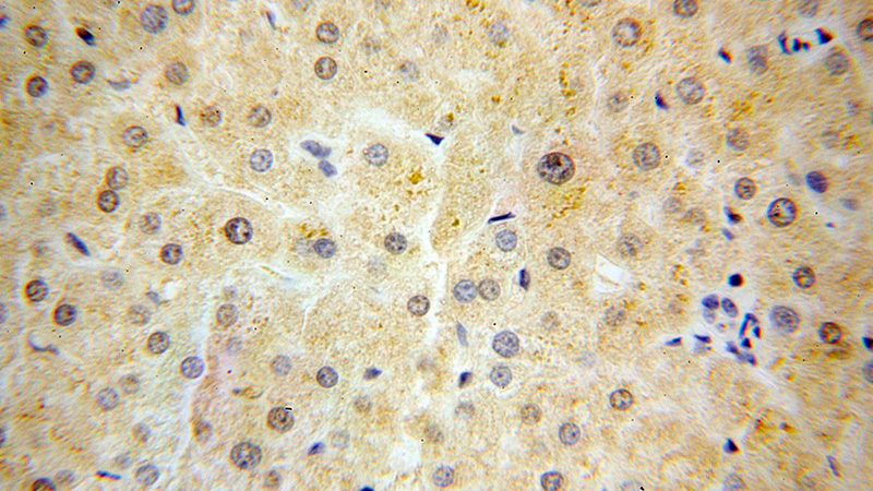 Immunohistochemical of paraffin-embedded human liver cancer using Catalog No:112161(LBP antibody) at dilution of 1:50 (under 40x lens)