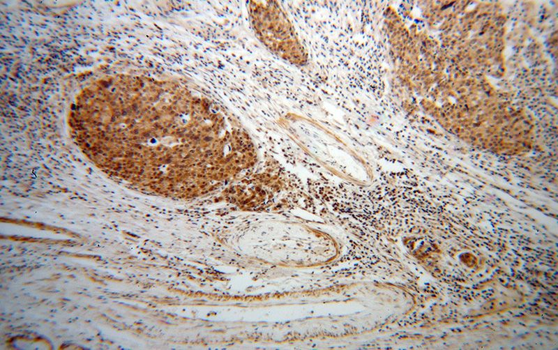 Immunohistochemical of paraffin-embedded human ovary tumor using Catalog No:110202(EIF4A2 antibody) at dilution of 1:100 (under 10x lens)