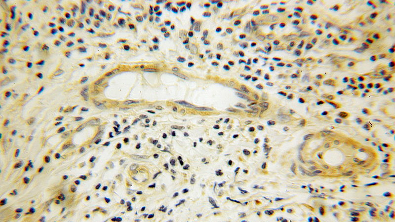 Immunohistochemical of paraffin-embedded human breast cancer using Catalog No:110134(KIAA0325 antibody) at dilution of 1:100 (under 10x lens)