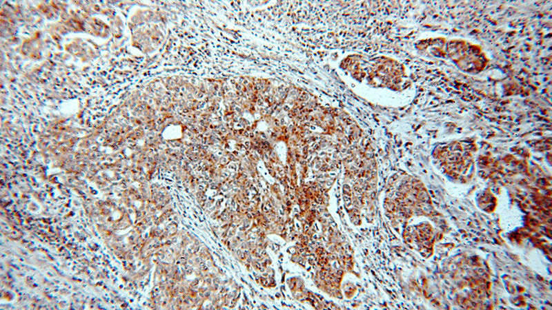 Immunohistochemical of paraffin-embedded human cervical cancer using Catalog No:113870(PIK3CA antibody) at dilution of 1:50 (under 10x lens)
