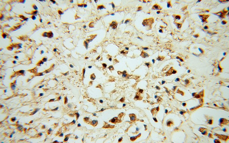 Immunohistochemical of paraffin-embedded human breast cancer using Catalog No:114955(S100A11 antibody) at dilution of 1:50 (under 40x lens)