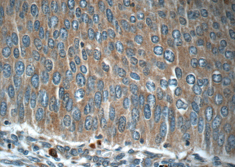 Immunohistochemistry of paraffin-embedded human cervical cancer tissue slide using Catalog No:108655(C13orf37 Antibody) at dilution of 1:50 (under 40x lens)