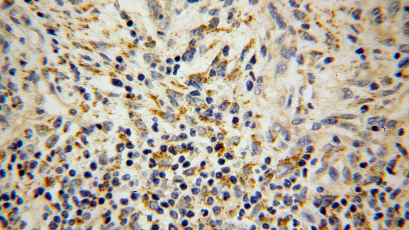 Immunohistochemical of paraffin-embedded human colon cancer using Catalog No:115074(SEC11A antibody) at dilution of 1:100 (under 40x lens)