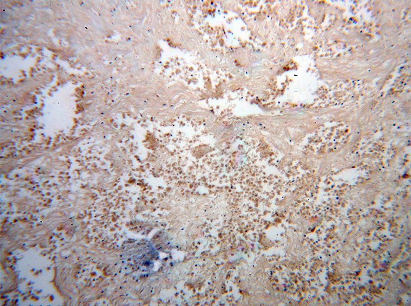 Immunohistochemical of paraffin-embedded human lung cancer using Catalog No:110750(FUT8 antibody) at dilution of 1:50 (under 10x lens)