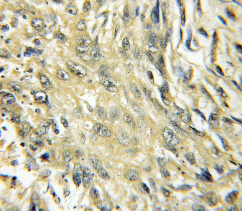 Immunohistochemical of paraffin-embedded human lung cancer using Catalog No:109704(CYP4B1 antibody) at dilution of 1:50 (under 10x lens)