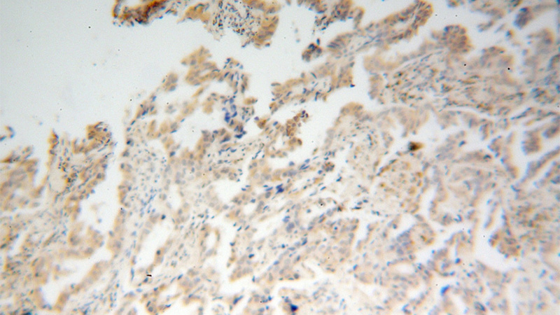 Immunohistochemical of paraffin-embedded human lung cancer using Catalog No:114583(RDH10 antibody) at dilution of 1:100 (under 10x lens)