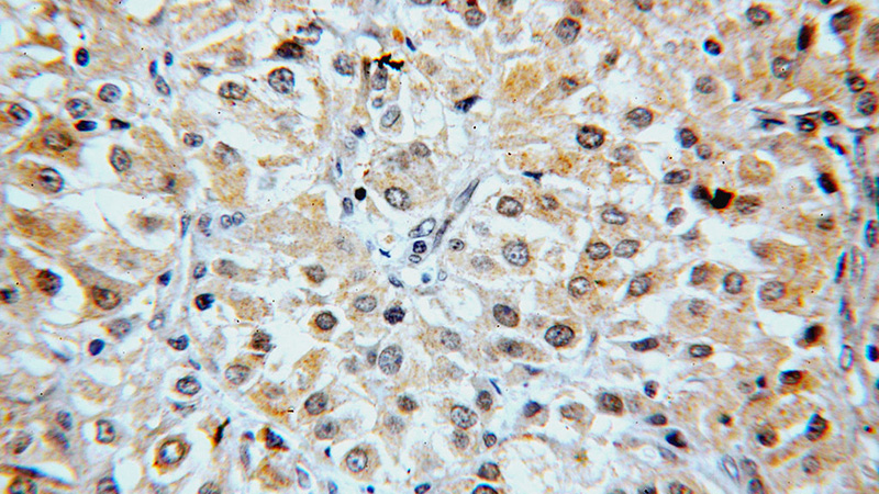Immunohistochemical of paraffin-embedded human renal cell carcinoma using Catalog No:110739(FNIP1 antibody) at dilution of 1:50 (under 40x lens)