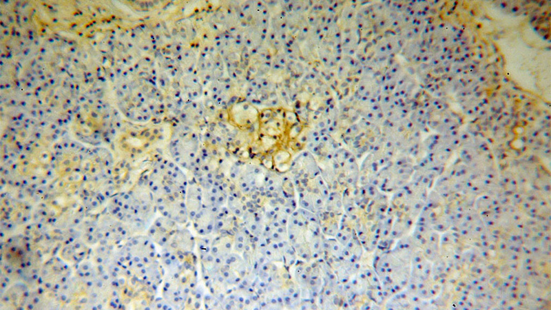 Immunohistochemical of paraffin-embedded human pancreas cancer using Catalog No:110994(GNB1 antibody) at dilution of 1:100 (under 10x lens)