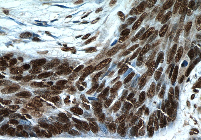 Immunohistochemistry of paraffin-embedded human skin cancer tissue slide using Catalog No:117326(Histone-H3 Antibody) at dilution of 1:50 (under 40x lens)