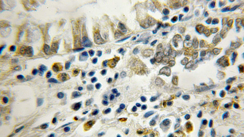 Immunohistochemical of paraffin-embedded human colon cancer using Catalog No:115491(SocS6 antibody) at dilution of 1:50 (under 10x lens)
