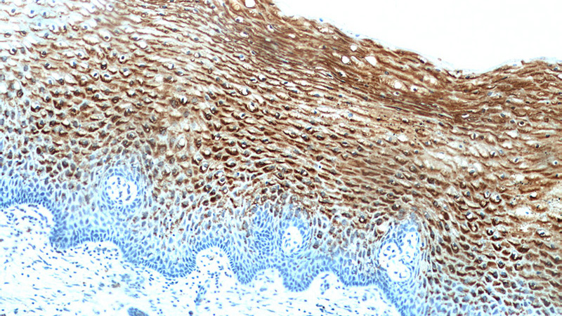 Immunohistochemical of paraffin-embedded human cervix using Catalog No:109983(DKK2 antibody) at dilution of 1:50 (under 10x lens)