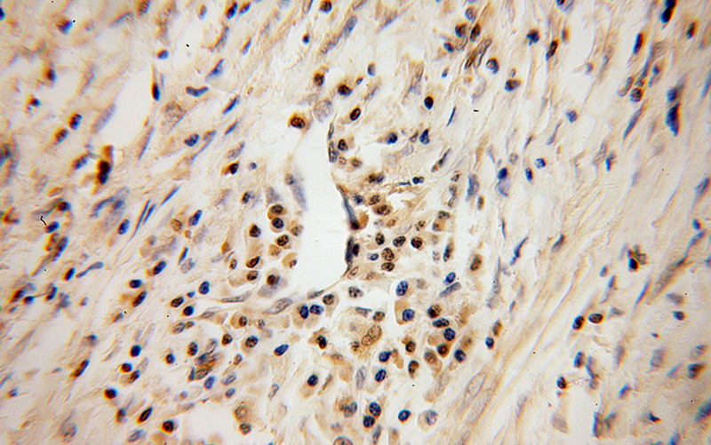 Immunohistochemical of paraffin-embedded human colon cancer using Catalog No:108191(ARID3A antibody) at dilution of 1:100 (under 40x lens)