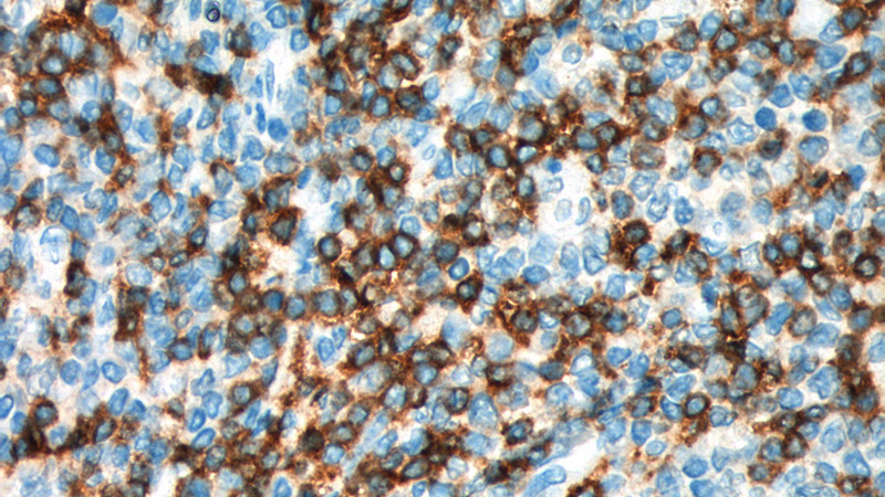 Immunohistochemistry of paraffin-embedded human tonsillitis tissue slide using Catalog No:107141(CD7 Antibody) at dilution of 1:200 (under 40x lens). heat mediated antigen retrieved with Tris-EDTA buffer(pH9).