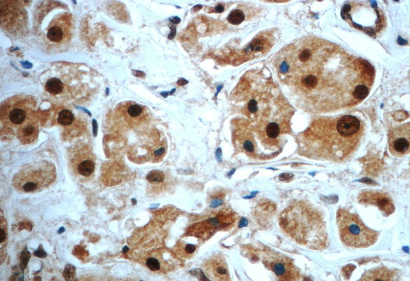 Immunohistochemistry of paraffin-embedded human breast cancer slide using Catalog No:115043(SAFB Antibody) at dilution of 1:50