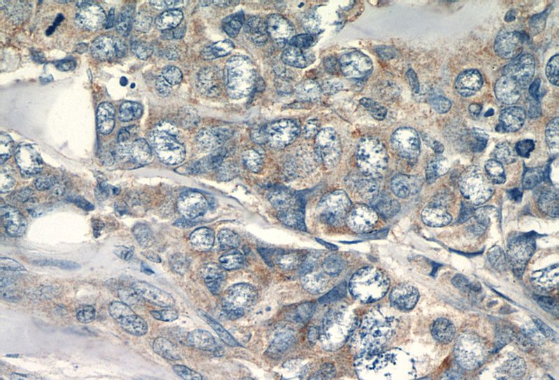 Immunohistochemical of paraffin-embedded human breast cancer using Catalog No:110462(FAM117B antibody) at dilution of 1:50 (under 40x lens)