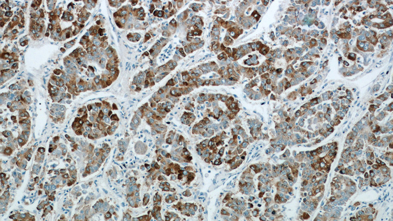 Immunohistochemical of paraffin-embedded human liver cancer using Catalog No:117089(B3GALT6 antibody) at dilution of 1:50 (under 10x lens)