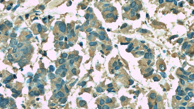 Immunohistochemistry of paraffin-embedded human prostate cancer slide using Catalog No:107216(FKBP2 Antibody) at dilution of 1:50