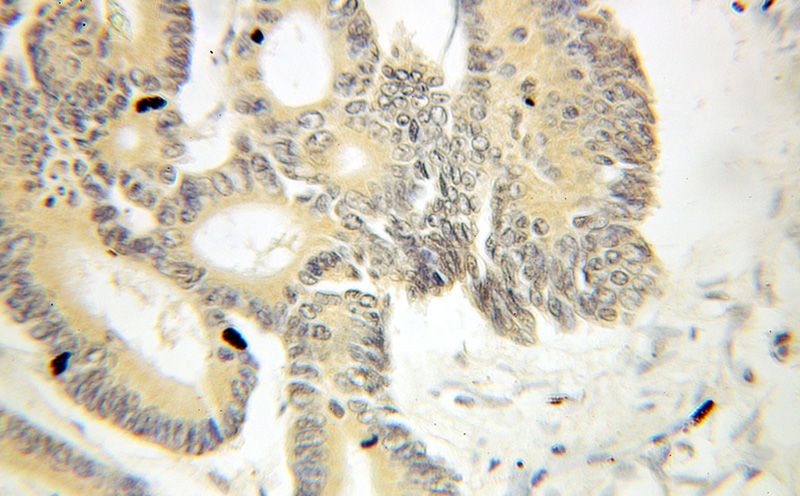 Immunohistochemical of paraffin-embedded human colon cancer using Catalog No:116046(THoc1 antibody) at dilution of 1:100 (under 10x lens)