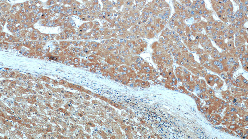 Immunohistochemical of paraffin-embedded human liver cancer using Catalog No:107912(AFP antibody) at dilution of 1:50 (under 10x lens)