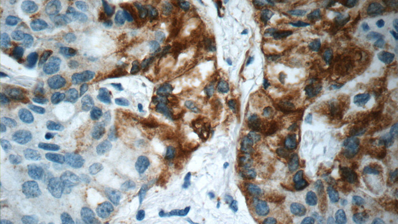 Immunohistochemistry of paraffin-embedded human lung cancer slide using Catalog No:112242(LIPC Antibody) at dilution of 1:50