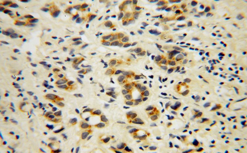 Immunohistochemical of paraffin-embedded human gliomas using Catalog No:107847(AHSA1 antibody) at dilution of 1:50 (under 40x lens)