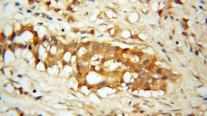 Immunohistochemical of paraffin-embedded human prostate cancer using Catalog No:108232(ASMTL antibody) at dilution of 1:100 (under 40x lens)
