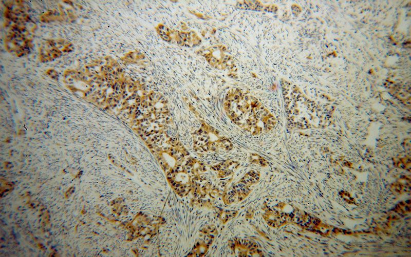 Immunohistochemical of paraffin-embedded human endometrial cancer using Catalog No:117090(B3GALTL antibody) at dilution of 1:50 (under 10x lens)