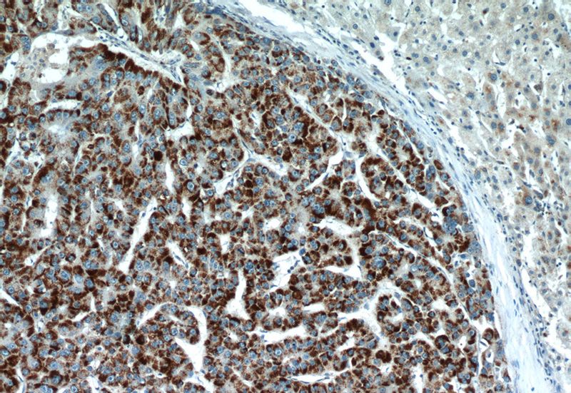 Immunohistochemical of paraffin-embedded human liver cancer using Catalog No:113727(PEX14 antibody) at dilution of 1:50 (under 10x lens)