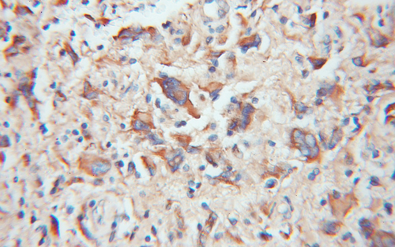 Immunohistochemical of paraffin-embedded human gliomas using Catalog No:116171(TOM20 antibody) at dilution of 1:100 (under 10x lens)