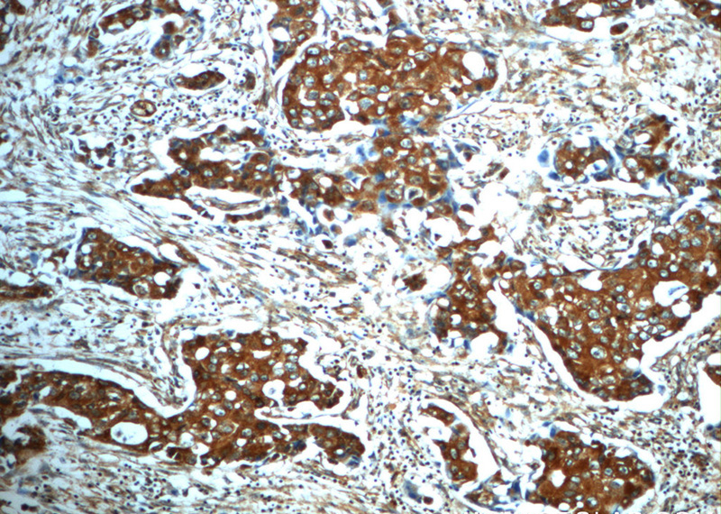 Immunohistochemistry of paraffin-embedded human breast cancer slide using Catalog No:108072(ANKRD26 Antibody) at dilution of 1:50