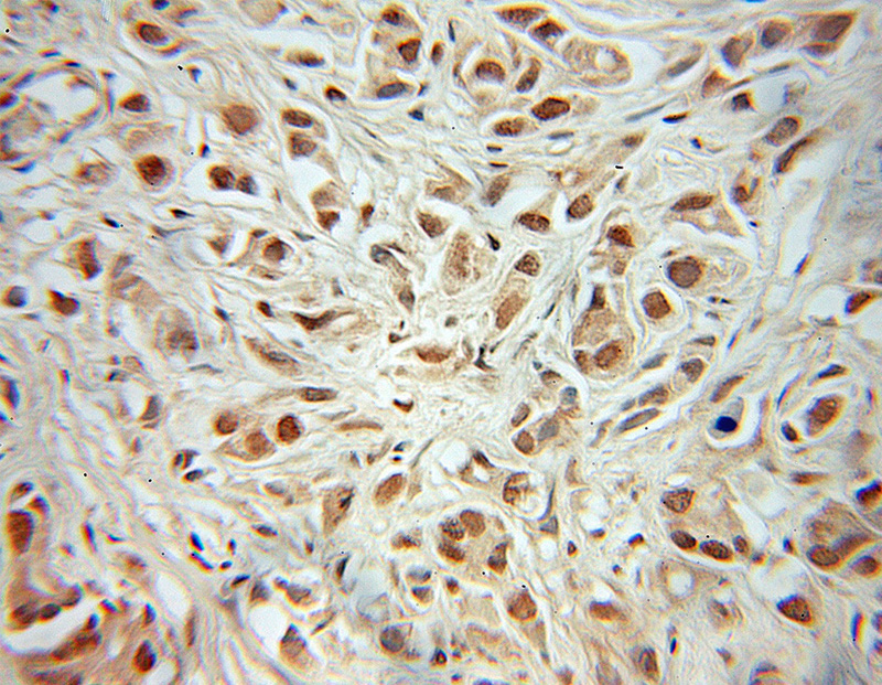 Immunohistochemical of paraffin-embedded human prostate cancer using Catalog No:112640(MEIS2 antibody) at dilution of 1:50 (under 10x lens)