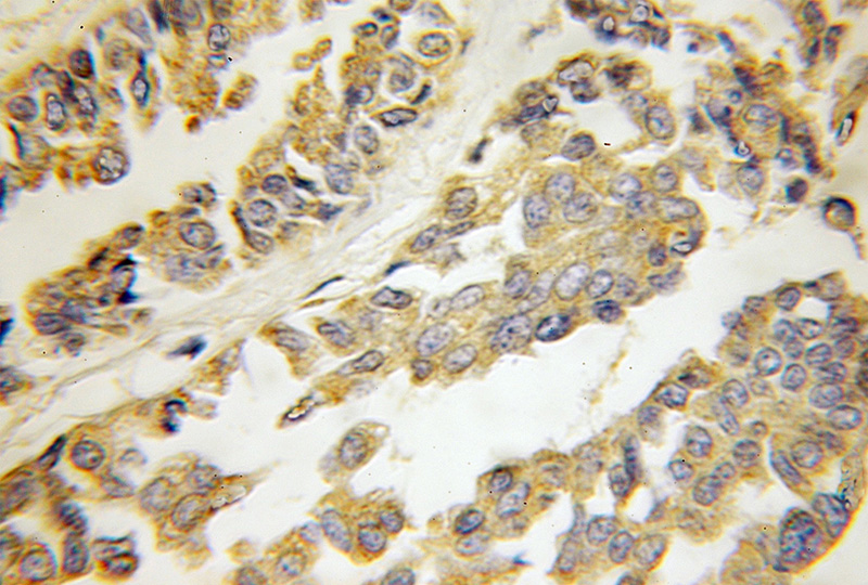 Immunohistochemical of paraffin-embedded human breast cancer using Catalog No:111257(HARS2 antibody) at dilution of 1:50 (under 10x lens)