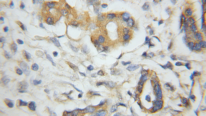 Immunohistochemical of paraffin-embedded human pancreas cancer using Catalog No:113954(PLEK2 antibody) at dilution of 1:50 (under 10x lens)